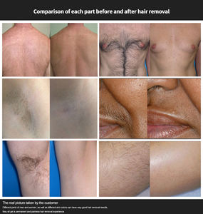 CE 인증 3000W 4파장 808nm 다이오드 레이저 제모기 755 808 1064 다이오드 레이저 제모 장비 - Product Image 5