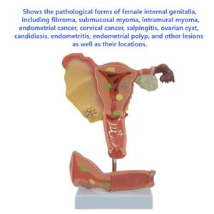 מודל הרחם פתולוגי (2-קטע)-הפאת הפתולוגיה הנשית - Product Image 6