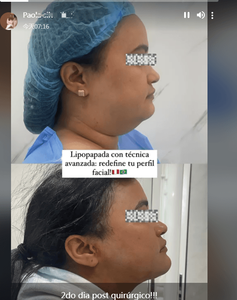 Endolifting laser 1470nm, liposuccion laser, raffermissement cutané, lifting facial par fibres, lipolyse endolaser 980nm, endovaser - Product Image 5