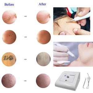 Appareil portable pour éliminer les taches noires du visage, les verrues, appareil de cautérisation, machine d'élimination des taches, élimination des taches brunes - Product Image 3