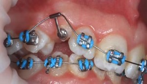 Prix usine de haute qualité Smile-ortho Advance appareil dentaire oeillet d'éruption orthodontique Tube simple/Double - Product Image 5