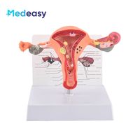 Modelo de anatomía del útero y ovario femenino Medeasy, modelo de útero normal y con enfermedades, con base desmontable para la enseñanza de enfermería médica