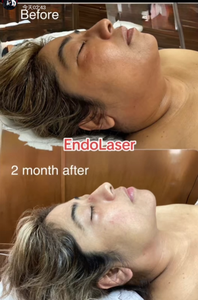 Appareil Endolaser 1470nm 980nm pour Liposuccion Corporelle, Lifting Facial, <span class=keywords><strong>Lipolyse</strong></span>, Élimination de la Graisse du <span class=keywords><strong>Double</strong></span> <span class=keywords><strong>Menton</strong></span> et Amincissement <span class=keywords><strong>par</strong></span> Fibres Derma - Product Image 3