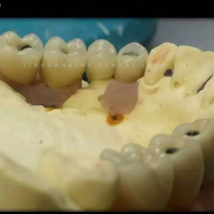 กล้องส่องทางไกลแบบครอบฟันรองรับฟันปลอม ivoclavar scheftner ผลิตตามสั่งไทเทเนียมห้องปฏิบัติการทันตกรรมจีน - Product Image 6