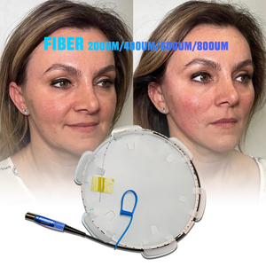 Eliminación de <span class=keywords><strong>Hemorroides</strong></span> y Varices, Cirugía Endolifting EVLT, Fibra Láser Médica Óptica Radial - Product Image 4