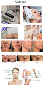 Vente en gros d'appareils Hifu 7D à ultrasons focalisés de haute intensité, machine de rajeunissement cutané non invasive, lifting du visage et du corps - Product Image 2