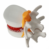 Modelo de demostración de enseñanza asistida, modelo de hernia de disco lumbar, modelo de disco intervertebral