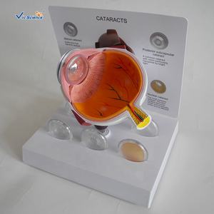 Modelo de Cataratas de Alta Calidad, Modelo de Glaucoma, Modelo de Ojo Patológico para Educación y Enseñanza. - Product Image 4