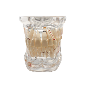Denti trasparenti per malattie di impianti dentali modello dentista trasparente Standard patologico - Product Image 3