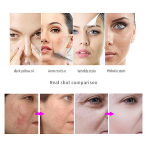เครื่องพ่นออกซิเจนคุณภาพสูง H2o2 Aqua Peel สำหรับดูแลผิวหน้า อุปกรณ์เสริมความงาม เครื่องผลัดเซลล์ผิวด้วยออกซิเจนแบบไมโครเดอร์มาเบรชั่น - Product Image 4