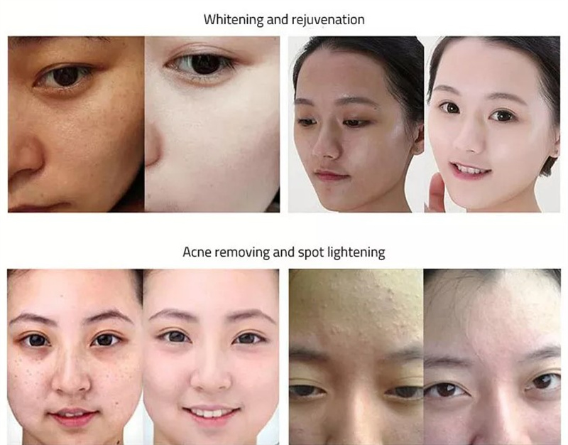OPT dpl IPL Elight Laser Remove Acne Vascular DPL Fast Hair Removal Painless Ipl Laser Epilator