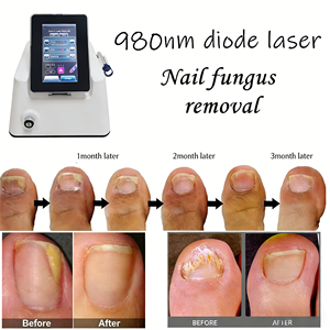 Laser 980nm untuk Mesin Penghilang Vaskular 4 in 1 Perawatan Jamur Kuku Vaskular - Product Image 2