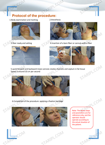 Mesin Laser Endolifting 980nm 1470nm Diode Laser yang Laris Manis dengan Serat Optik 200um 400um 600um - Product Image 4