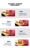 Pièces et accessoires de pièce à main laser à diode double longueur d'onde 980nm + 1470nm pour les traitements gynécologiques et vaginaux et le raffermissement cutané