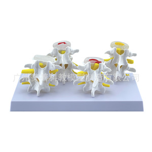 Quatre équipes de modèles pathologiques de la colonne vertébrale lombaire, quatre paires de modèles de lésions des disques lombaires, modèles de pathologie des disques intervertébraux - Product Image 2