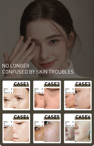 Appareil de microdermabrasion 14-en-1 Hydro Dermabrasion, exfoliant cutané, traitement facial à l'oxygène, soin ciblé pour les yeux, pulvérisation anti-acné EU/UK/US/IT - Product Image 6
