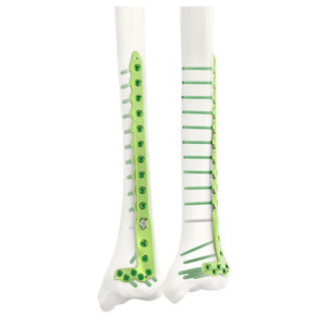 Placa de bloqueo pediátrica de alto rendimiento para implantes de fractura al por mayor, 5.0mm, para usar con tornillo cortical autorroscante de bloqueo 5.0 - Product Image 3