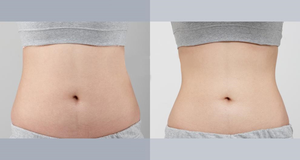 Máy tính để bàn chuyên nghiệp 980nm + 1470nm chất béo hòa tan lipolysis endolaser mặt nâng Máy giảm béo - Product Image 5