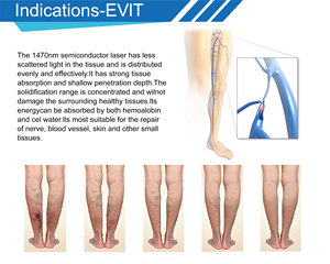 Macchina Keylaser Medical 980nm 1470nm Endolaser per Lifting, Taglio Emorroidi con Fibra, EVLT, EVLA, Rimozione <span class=keywords><strong>Vene</strong></span> Endovascolari - Product Image 4