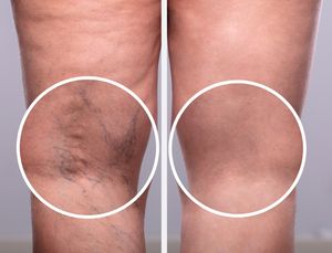 Máquina de Tratamiento de Venas Varicosas con Láser de 1470nm, Eliminador de Venas Varicosas en las Piernas - Product Image 6