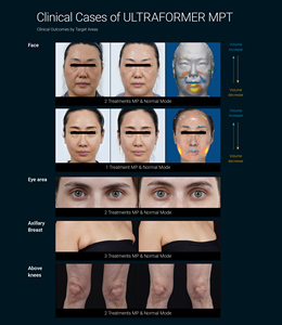 Appareil de beauté vertical à ultrasons pour le visage et le corps, machine de raffermissement et de remodelage de la peau avec 3 poignées et plusieurs cartouches pour <span class=keywords><strong>spa</strong></span> - Product Image 5