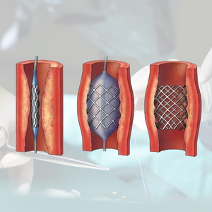 Tubos de Nitinol para la Fabricación de Stents Vasculares Coronarios y Periféricos - Product Image 3