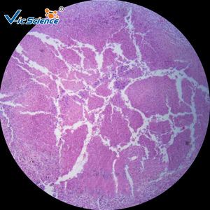 Lung abscess biological section, medical histology, <b>microscope</b> for teaching and research, medical school laboratory. - Product Image 4