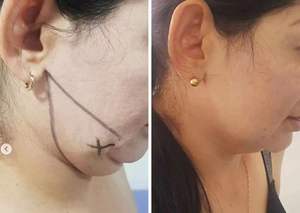 Draagbare Medische Lipolyse Diode Laser 980 + 1470Nm Liposuctie Vet Chirurgie Lichaam Afslanken Gewicht Verlies Machine - Product Image 5