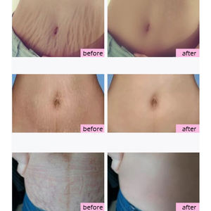 Lotion <span class=keywords><strong>Anti</strong></span>-vergetures, produit de corée pour enlever la <span class=keywords><strong>Cellulite</strong></span> <span class=keywords><strong>et</strong></span> les vergetures de marque, Lotion, ml - Product Image 2