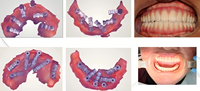 Kit de escaneo dental HAT de alta precisión, herramienta de escaneo de implantes Panda, compatible con escaneo intraoral Osstem Dentium, aleación de titanio