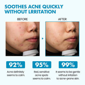 Aha Bha Pha Creme Acne Cuidados Esfoliante Rapidamente Acalma Clareamento Sensível Pele Private Label Rosto Creme Hidratante - Product Image 4