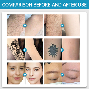 <strong>Z</strong> Multifunction 4-in-1 Tattoo Removal Machine ND YAG Laser IPL <strong>Pico</strong> Lase Beauty Machine for Body Armpit Hair Removal Anti-Aging - Product Image 6