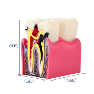 Azdent modello di insegnamento dentale 6 volte carie due lato contrasto anatomico per l'educazione del paziente e spiegazione - Product Image 6