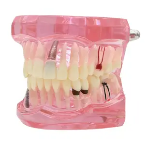 दंत दांत मॉडल प्रत्यारोपण अध्ययन विश्लेषण परीक्षण के साथ दांत मॉडल