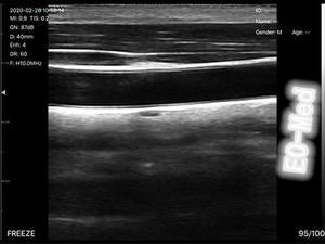 Mesin <span class=keywords><strong>Ultrasound</strong></span> portabel nirkabel 128 elemen 7.5MHz <span class=keywords><strong>Probe</strong></span> <span class=keywords><strong>Ultrasound</strong></span> Linear Harga bagus model BW12 - Product Image 5