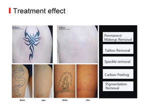 เครื่องเลเซอร์ Nd Yag แบบพกพาสําหรับการกําจัดรอยสัก เครื่องเลเซอร์ Nd Yag การซักผ้าอายไลเนอร์ - Product Image 3