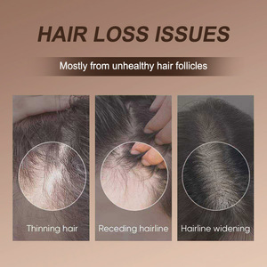 Champú de Limpieza Profunda, Eliminador de Acumulaciones - Champú Desengrasante para Cabello y <span class=keywords><strong>Cuero</strong></span> <span class=keywords><strong>Cabelludo</strong></span> Grasos - Product Image 5