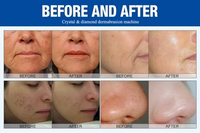 Appareil multifonctionnel de soin du visage de qualité hospitalière pour un nettoyage en profondeur des pores, traitement au plasma froid, machine à fibroblastes, acné