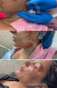 Láser de lipólisis Endoliftin de 1470nm para relleno de glúteos BBL, inyecciones de lipólisis de grasa de 980nm, lifting facial, lipólisis, liposucción - Product Image 6