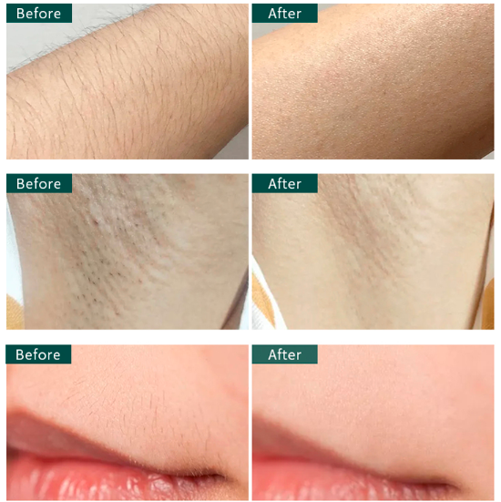 1200W Permanent Ice Clear Diode Machine 808 Laser Ipl Hair Removal