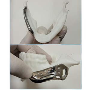 Mandíbula de Titanio de Excelente Calidad, Hecha a Medida, Alta Resistencia, Estructura de Mandíbula Precisa y Duradera, Disponible al Mejor Precio - Product Image 1