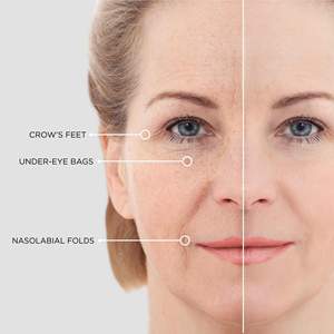 Dissolving Micro Needles Eye Patch With Hyaluronic Acid and Peptides Moisturizing Mask Factory OEM <strong>Skyn</strong> Iceland - Product Image 5