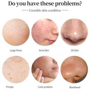 Tratamiento para el Acné con Ácido Salicílico, Suero con 1.5% de SA y Niacinamida para Piel Propensa a Imperfecciones, Elimina el Acné, Esencia GZ RTS, Pedido Mixto al por Mayor - Product Image 3