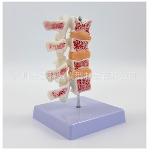 Simulation pédagogique de l'ostéoporose humaine, de la colonne vertébrale, des vertèbres lombaires, du squelette, de la structure osseuse, de la pathologie, des intervertèbres lombaires - Product Image 3