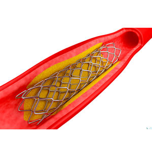 Tubos Médicos de Nitinol de Pared Delgada para Aplicaciones de Stents Coronarios - Product Image 3