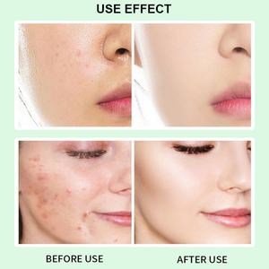 Suero Facial para el Cuidado de la Piel de 30 ml, Elimina el Acné Profundo, Aclara la Piel, con 2% de Ácido Salicílico - Product Image 5