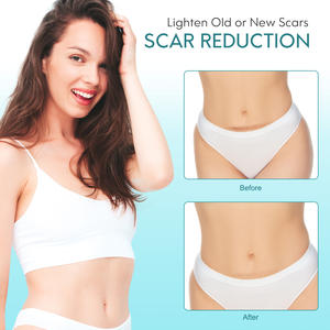 Elaimei Silicon Repair Damage Scar Sheet Gel Venta caliente Eliminación <span class=keywords><strong>de</strong></span> <span class=keywords><strong>cicatrices</strong></span> y marcas Acné Productos <span class=keywords><strong>de</strong></span> eliminación <span class=keywords><strong>de</strong></span> <span class=keywords><strong>cicatrices</strong></span> antiguas - Product Image 2