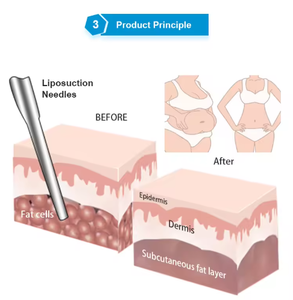 Appareil de beauté multifonctionnel 3-en-1 2026 en ABS, avec injection d'eau et aspiration pour l'élimination des graisses - Product Image 2
