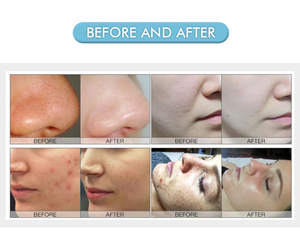 Máquina de Belleza 2 en 1 para Limpieza Facial con Hidrodermoabrasión, Equipo de Spa para Rejuvenecimiento Facial, Marca <span class=keywords><strong>Taibo</strong></span> - Product Image 6