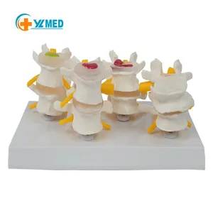 Medical Science Human pathological lumbar spine model 4 stage real lumbar spine lesion display model medical learning tool